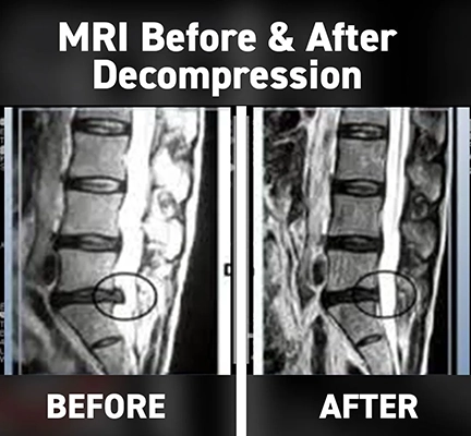 Chiropractic Alpharetta GA Spinal Decompression Before And After